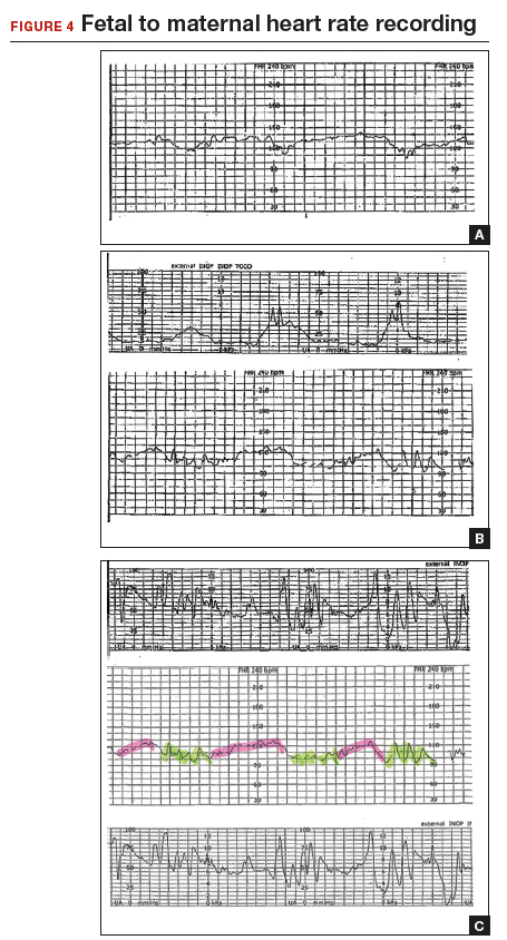 How To Differentiate Maternal From Fetal Heart Rate Patterns On Electronic Fetal Monitoring Mdedge Obgyn