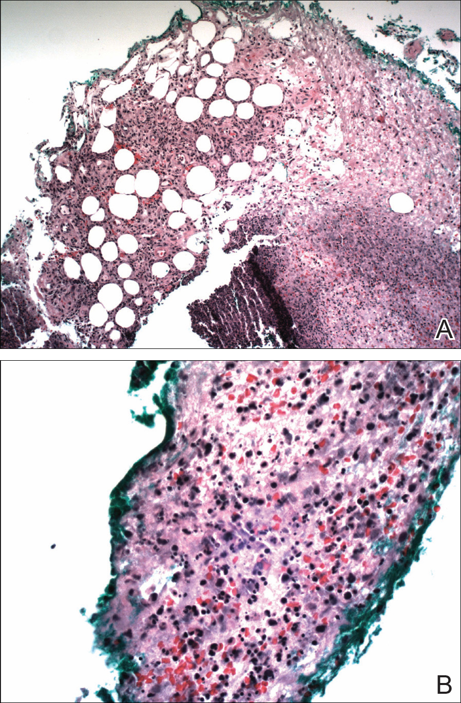 Sweet Syndrome With Aseptic Splenic Abscesses and Multiple Myeloma ...