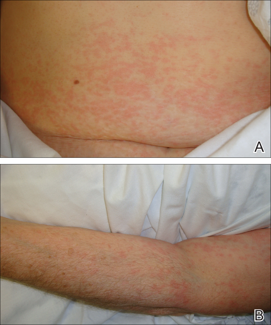 What does an allergic reaction to gabapentin look like