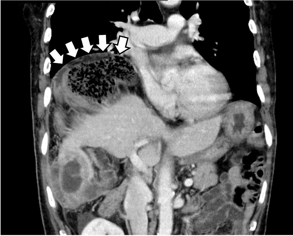 Figure 2. The Chilaiditi sign on computed tomography, with volvulus of the cecum between the diaphragm and liver and a closed-loop obstruction (arrows).