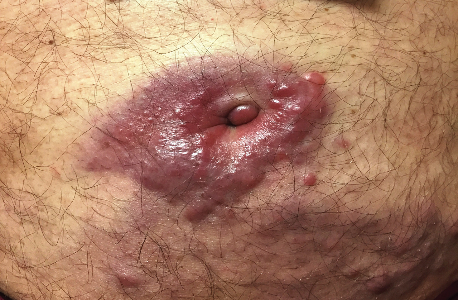 Nipple rash  MDedge Family Medicine