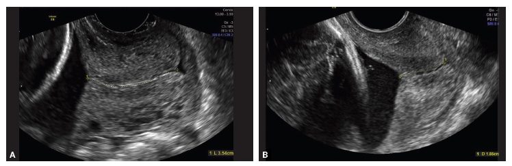 Universal Cervical Length Screening saving Babies Lives MDedge ObGyn