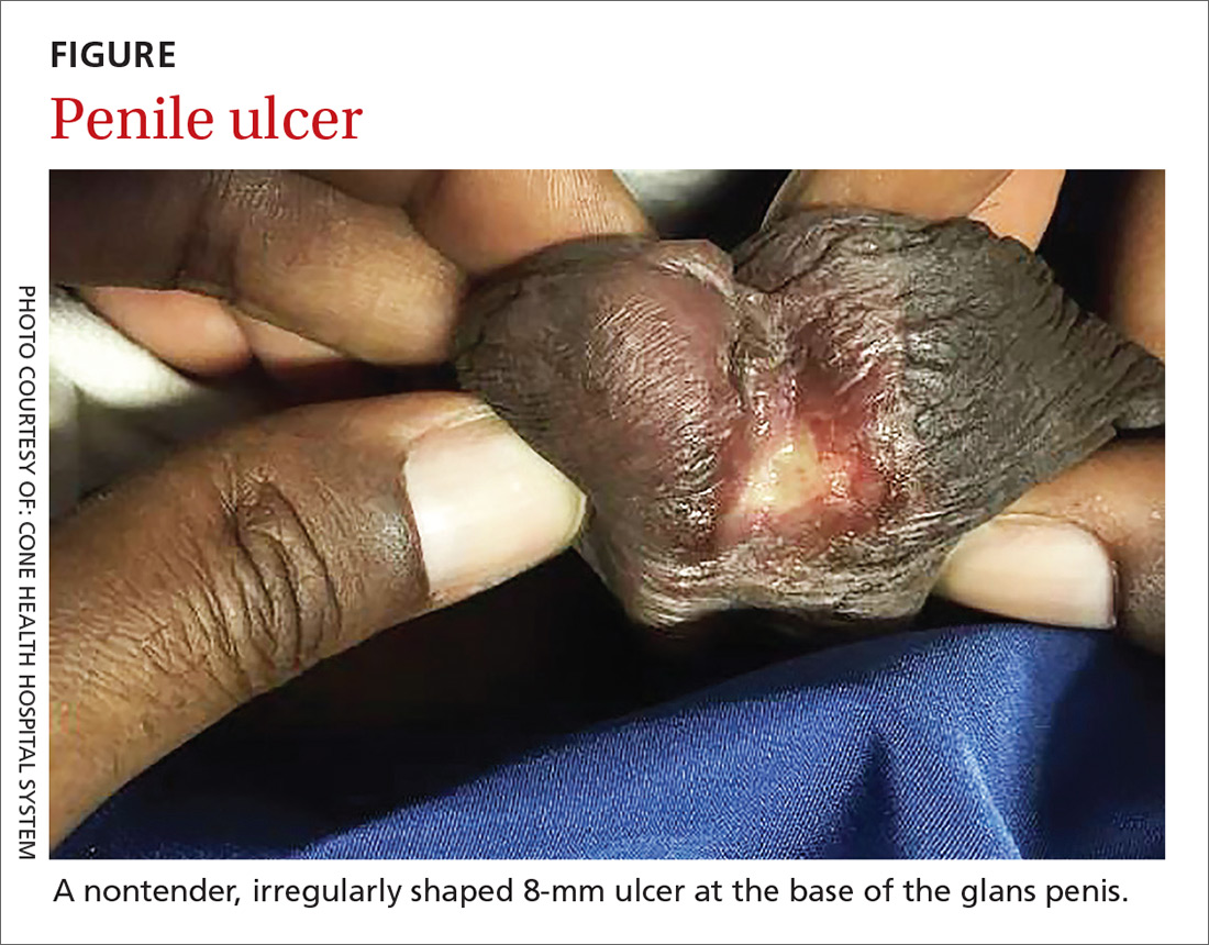 Painless penile ulcer and tender inguinal lymphadenopathy Clinician Reviews