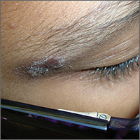 Rash on eyebrows