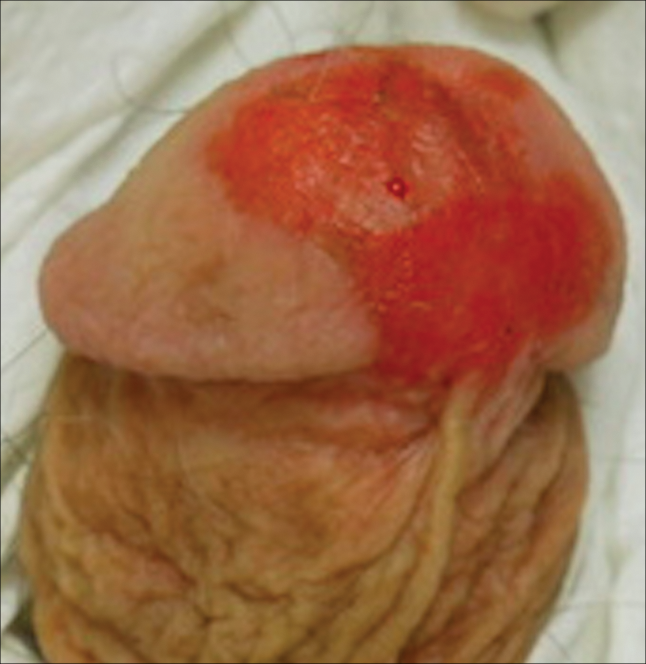 simptome rinichi bolnav negi genitale infecție internă