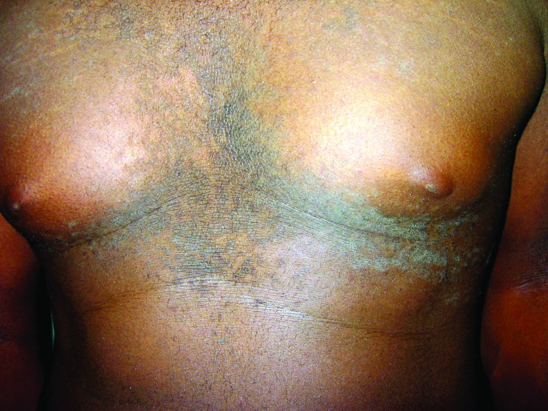 Papillomatosis confluent and reticulated Confluent reticulated papillomatosis causes