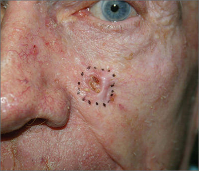 Growing lesion on cheek