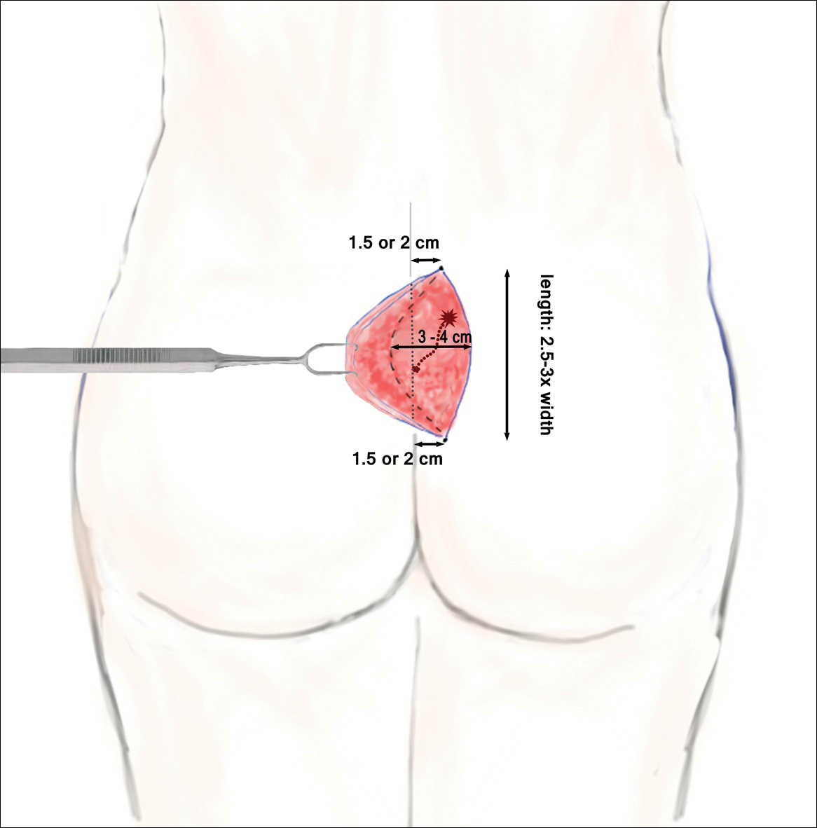 Pilonidal Cystectomy Technique: Approach Considerations, Simple Cystectomy,  Techniques for Complicated or Recurrent Disease