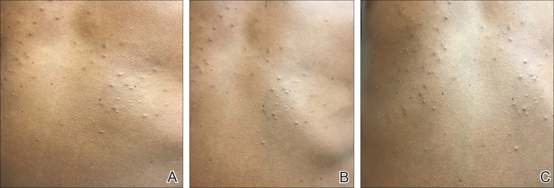 Eruptive Vellus Hair Cysts in Identical Triplets With Dermoscopic Findings  | MDedge Dermatology