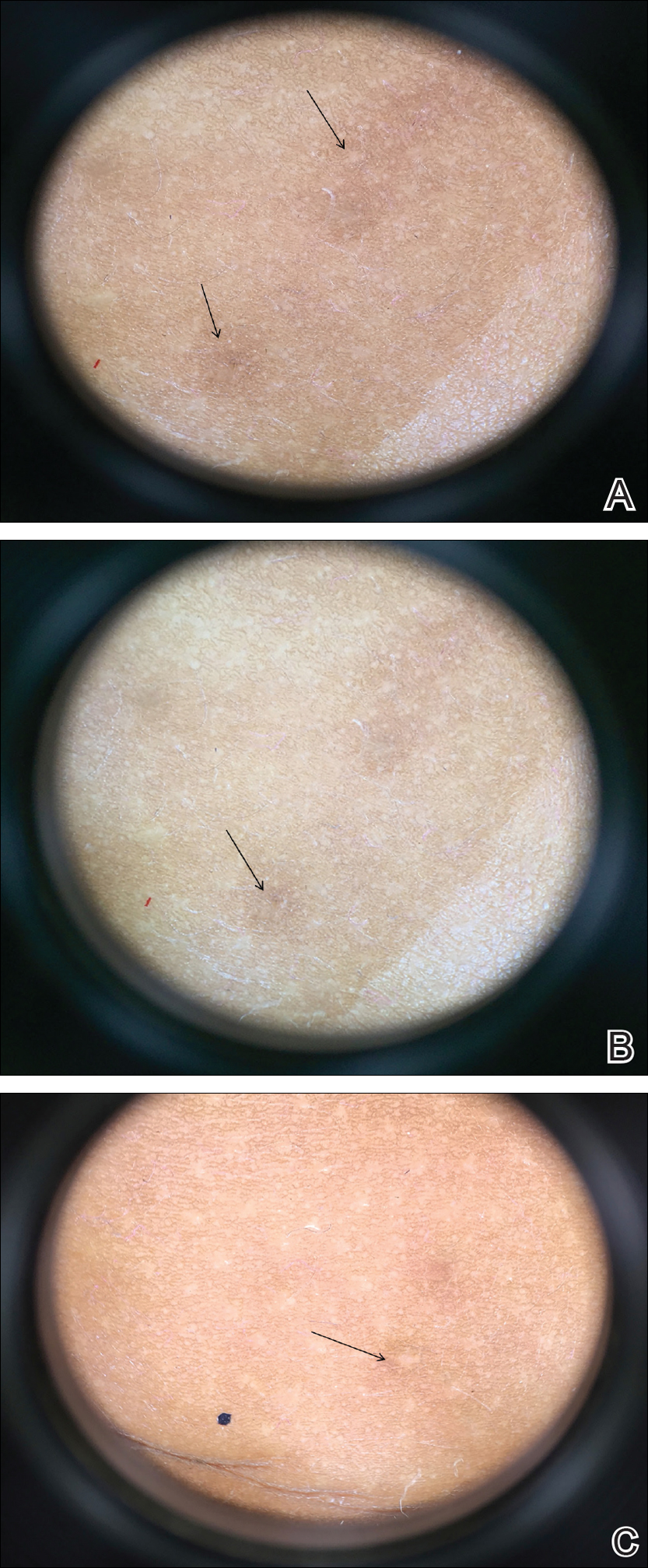 Eruptive Vellus Hair Cysts in Identical Triplets With Dermoscopic Findings  | MDedge Dermatology