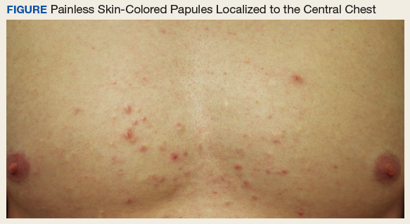 papules skin