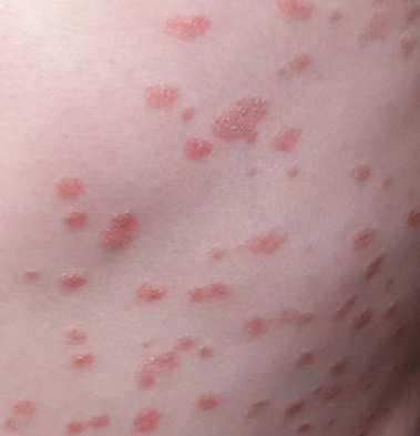 What is This Rash?