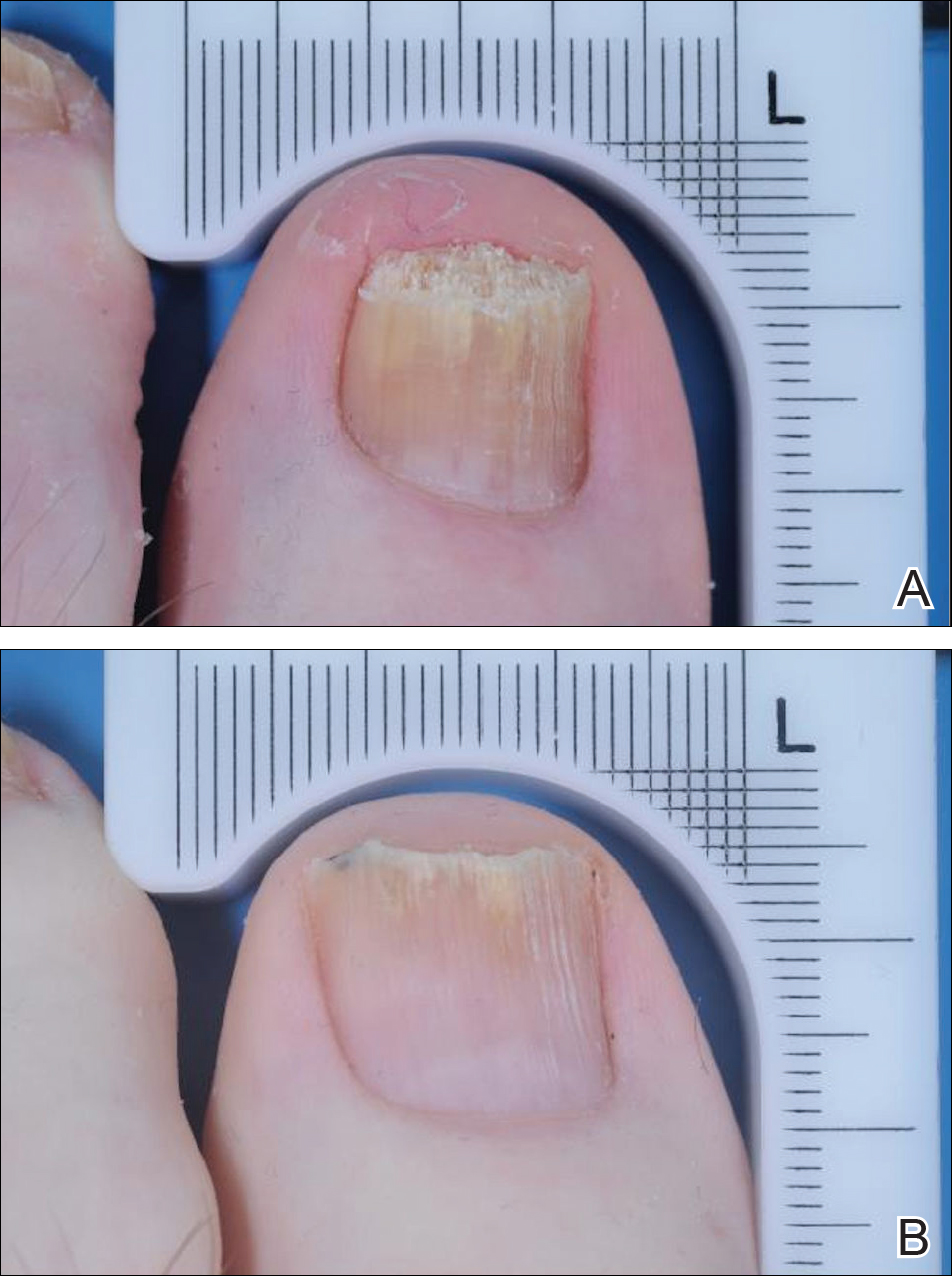 Secondary Onychomycosis Development after Cosmetic Procedure-Case Report