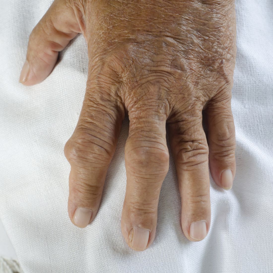 ревматоидный артрит пальцы фото