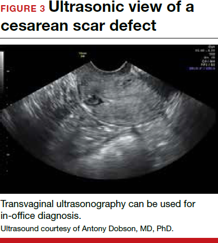 cesarean section abnormal presentation