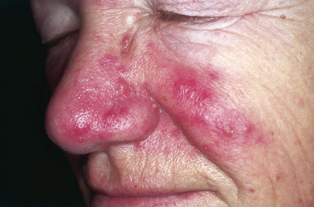 Rosacea: Inflammatory papules and pustules observed over the nose in an individual with rosacea.