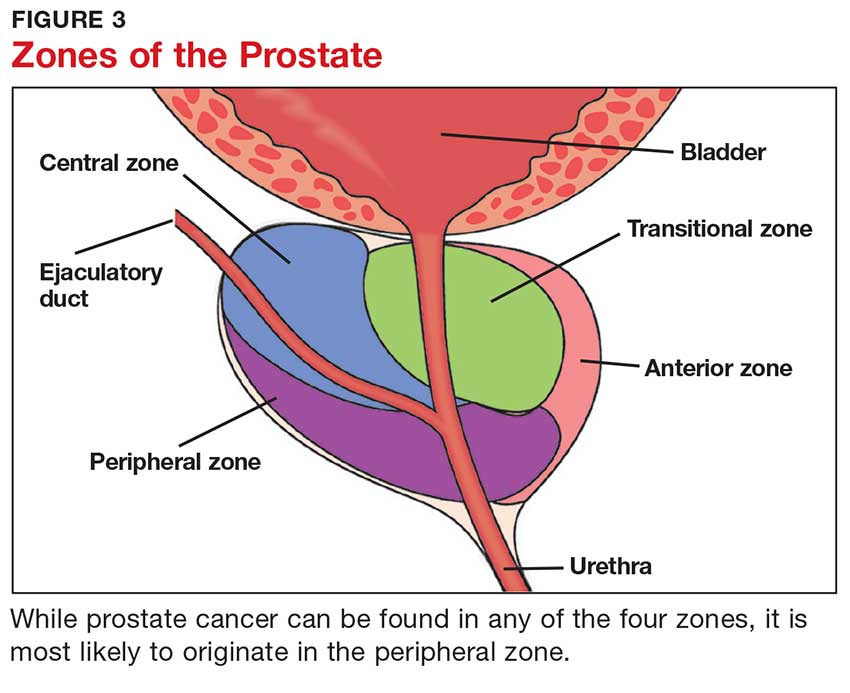 bph vs prostate cancer zone
