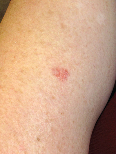 Hiv Rash On Forearm One Of Hiv Symptoms Is Rash Majestic Glow