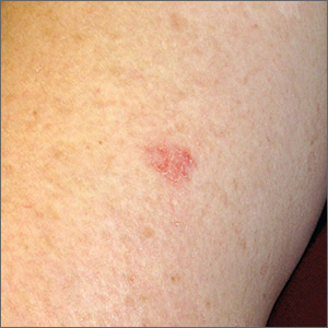 Rash on arm