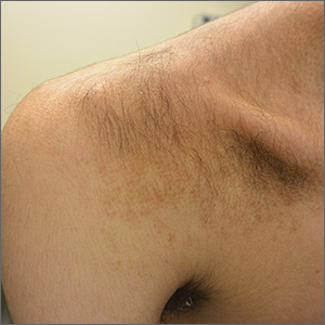 Progressive discoloration over the right shoulder