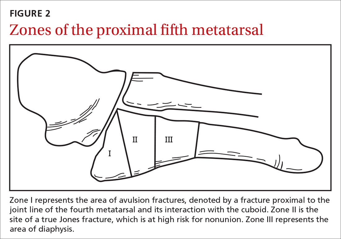 Adult Foot Fractures A Guide Clinician Reviews 4575