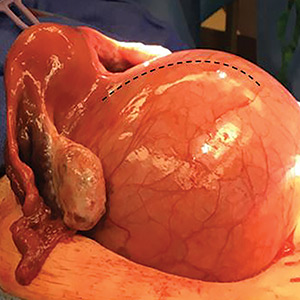 Uterine fibroid being removed via a myomectomy