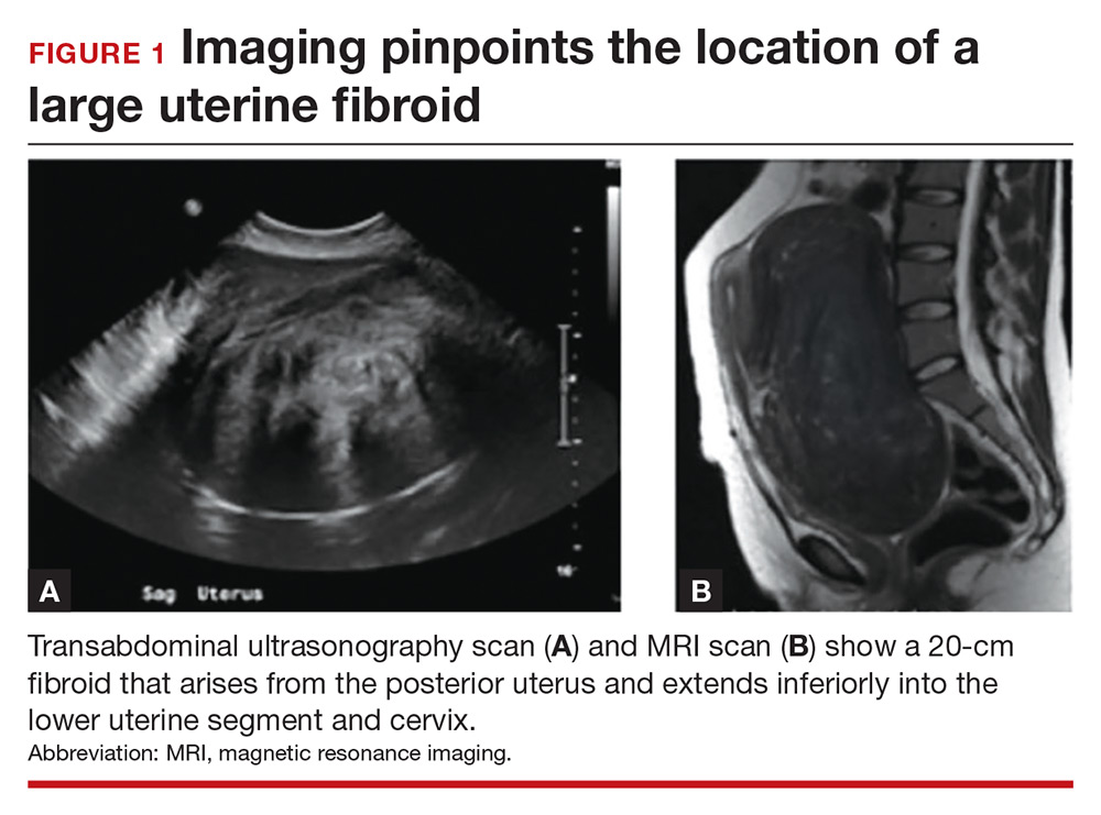 Myomectomy Of A Large Cervical Fibroid In A Patient Desiring Future 