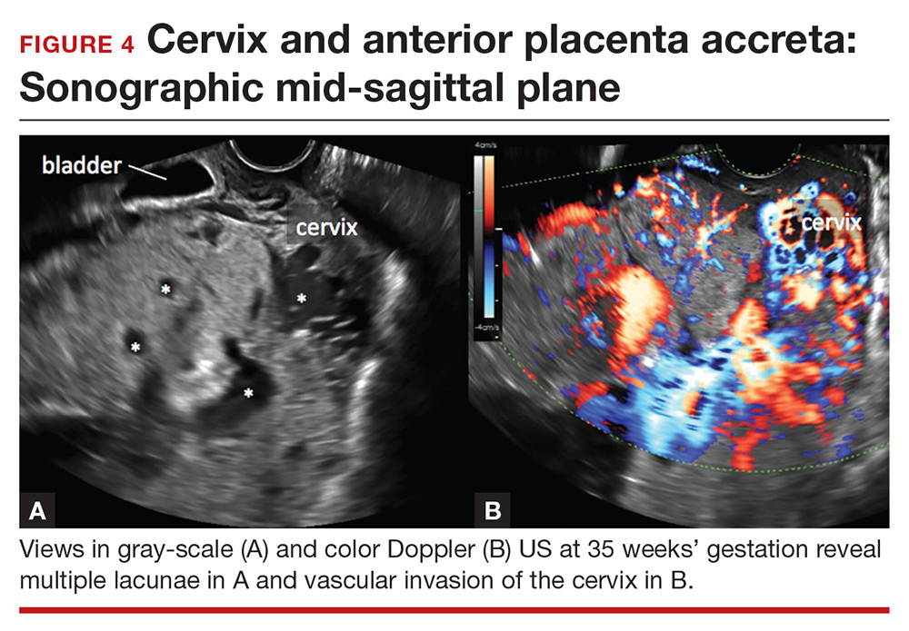 Placenta Accreta Ultrasound Diagnosing Placenta Accreta Spectrum With