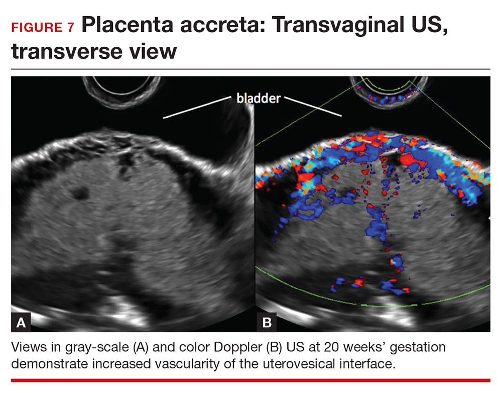 Placenta Increta Ultrasound | Hot Sex Picture