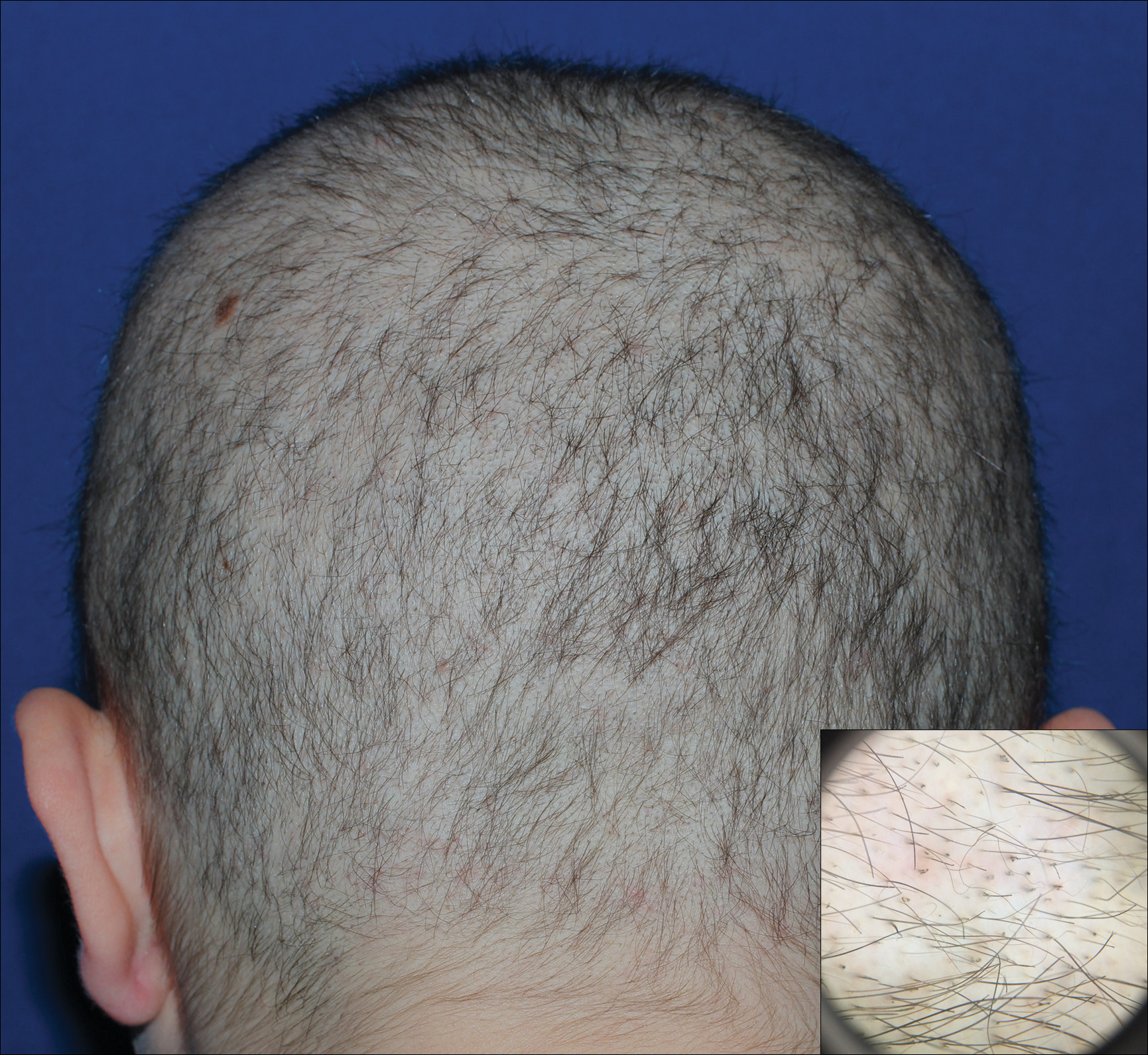 Diffuse Nonscarring Alopecia | MDedge Dermatology
