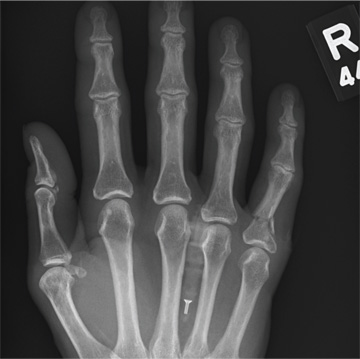 Hand Slammed in Door | Clinician Reviews