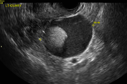subcutaneous dermoid cyst ultrasound
