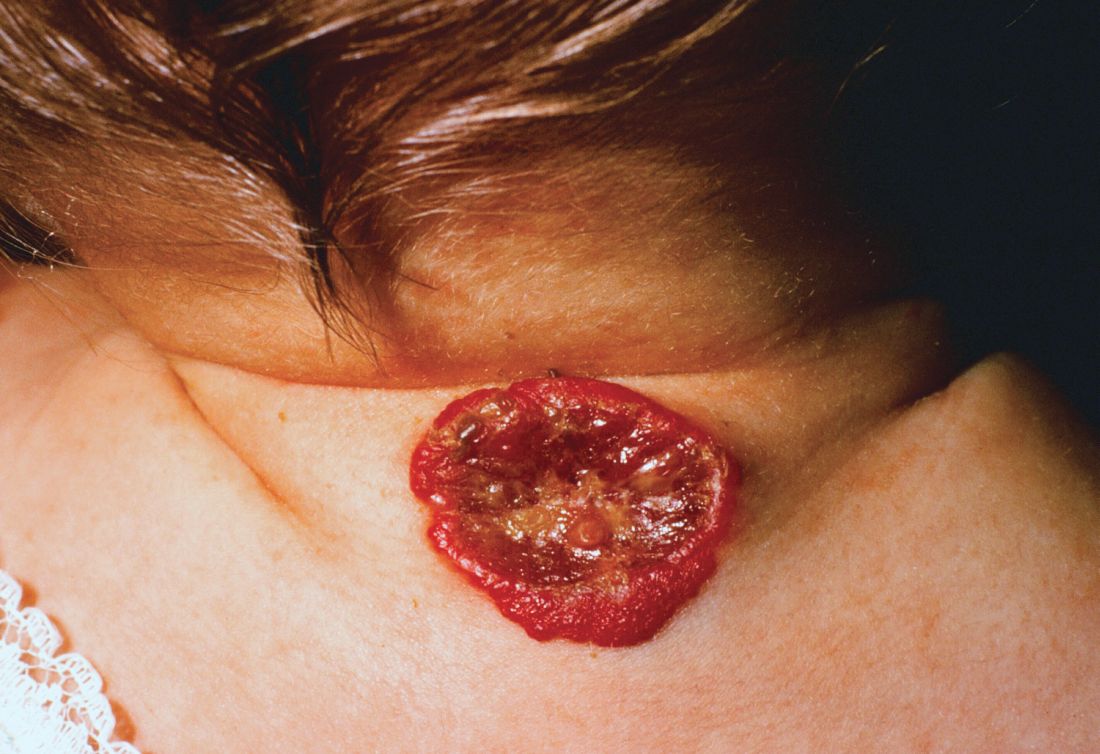 An ulcerated hemangioma