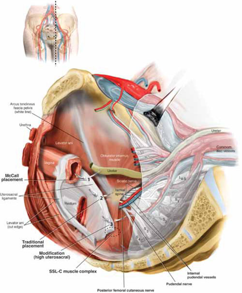 uterosacral ligament ureter