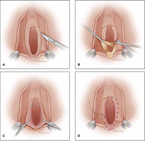 vulvar vestibulectomy