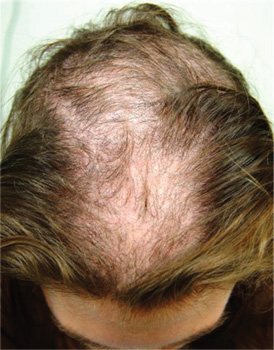 Hair Loss at a Very Young Age | Clinician Reviews