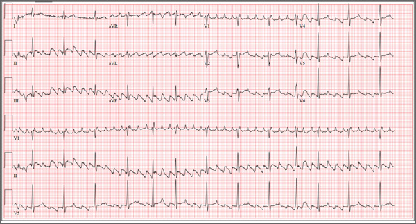 normal ecg vs heart attack ecg