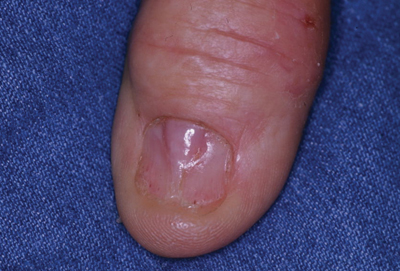 Tender Thumbnail Papule | MDedge Dermatology