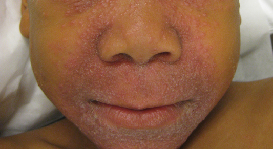 Nonpruritic Papular Facial Eruption Mdedge Dermatology