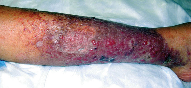 Erythematous Nodular Plaque Encircling the Lower Leg