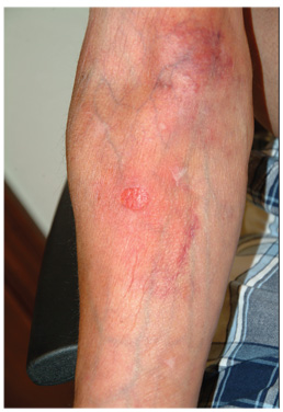 Topical Steroids: the Solution or the Cause?