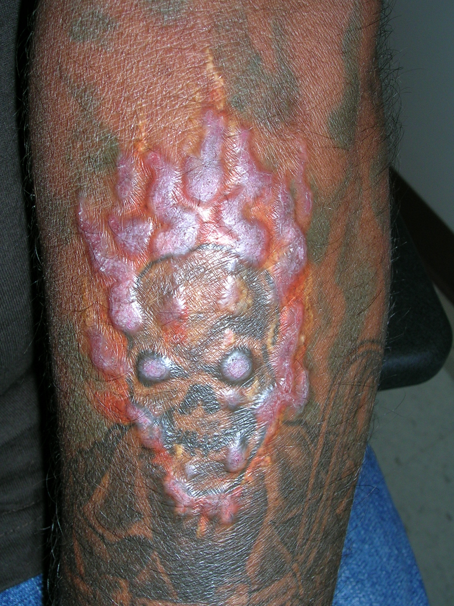 Pseudoepitheliomatous Hyperplasia Arising From Purple Tattoo Pigment |  MDedge Dermatology
