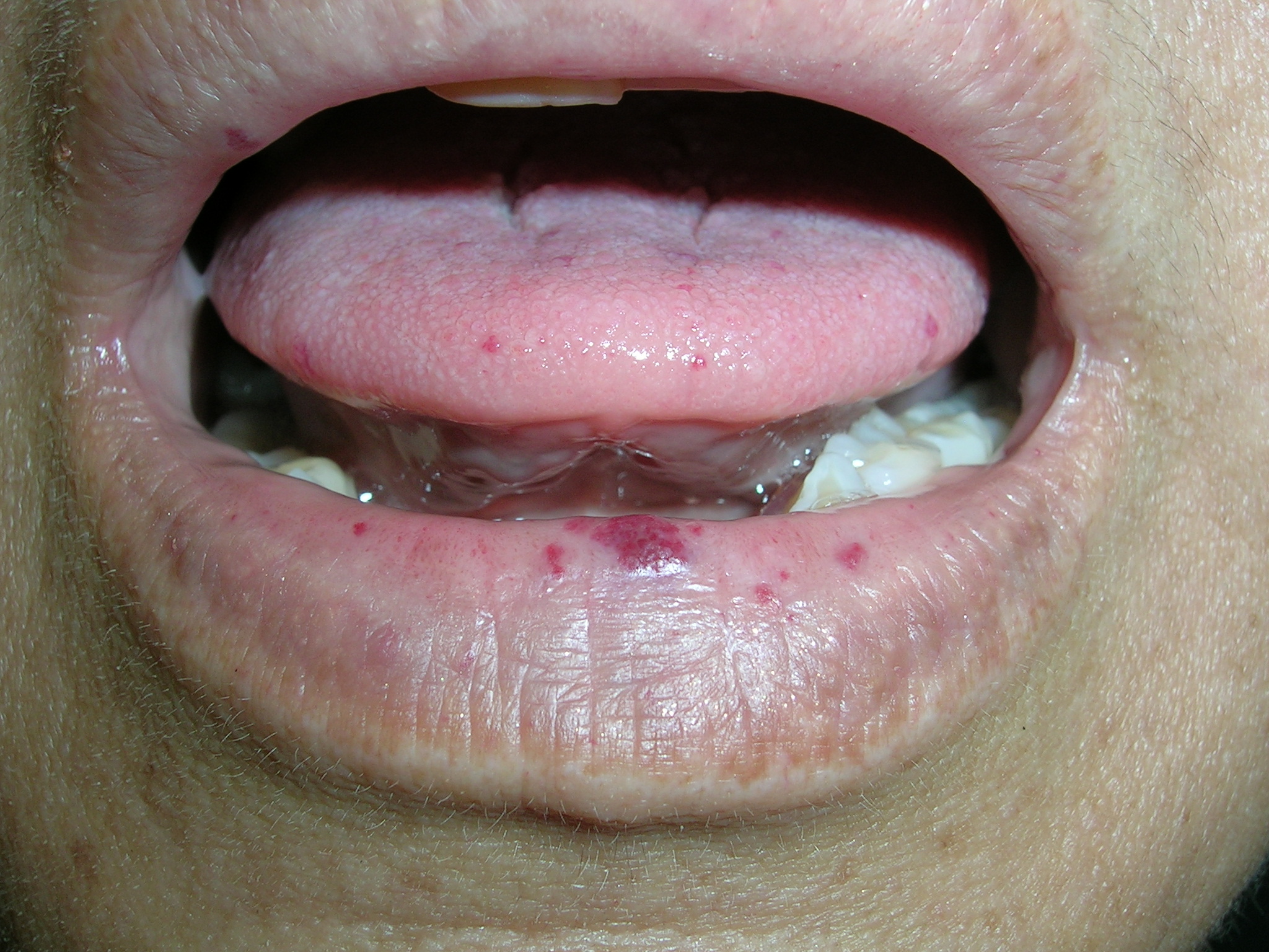 Small Tongue Irritation at Byron Davis blog