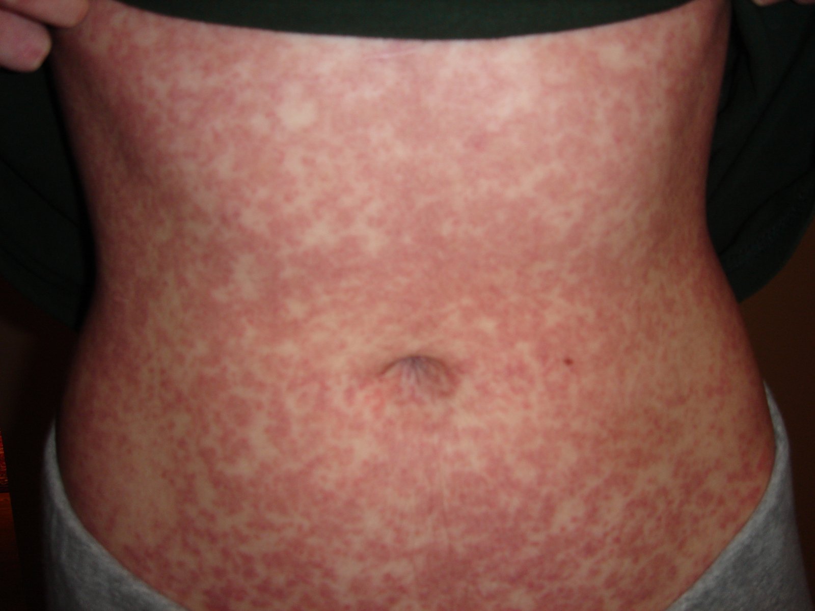 Body Rash MDedge Family Medicine