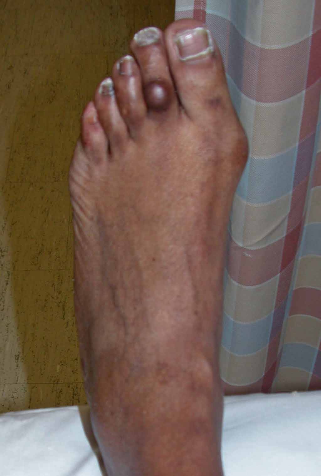 hard toe