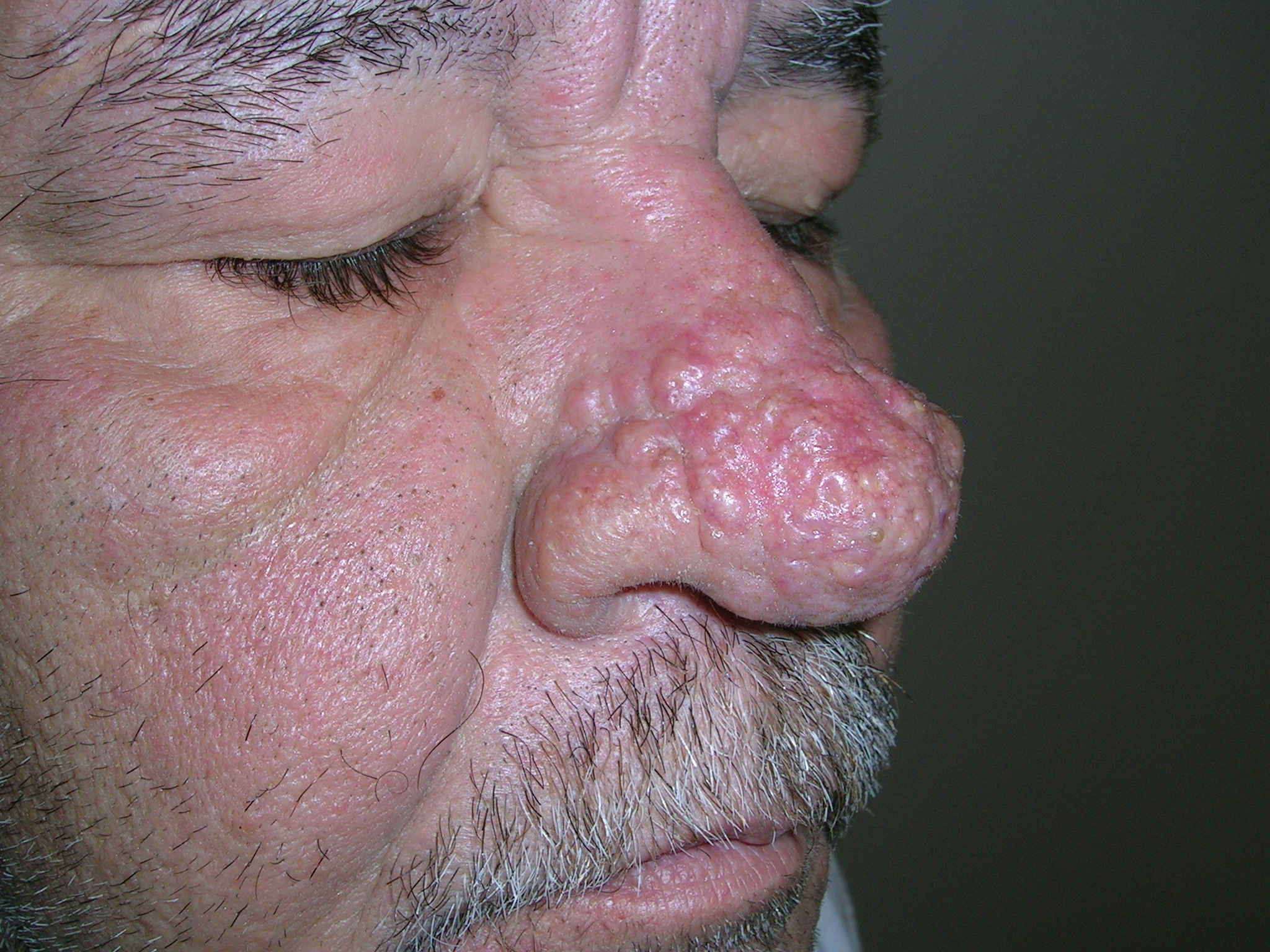rosacea nose bumps