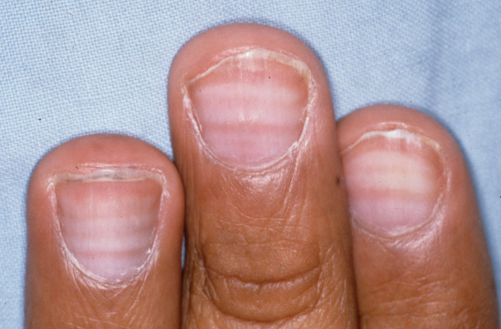 Lines across fingernails MDedge Family Medicine