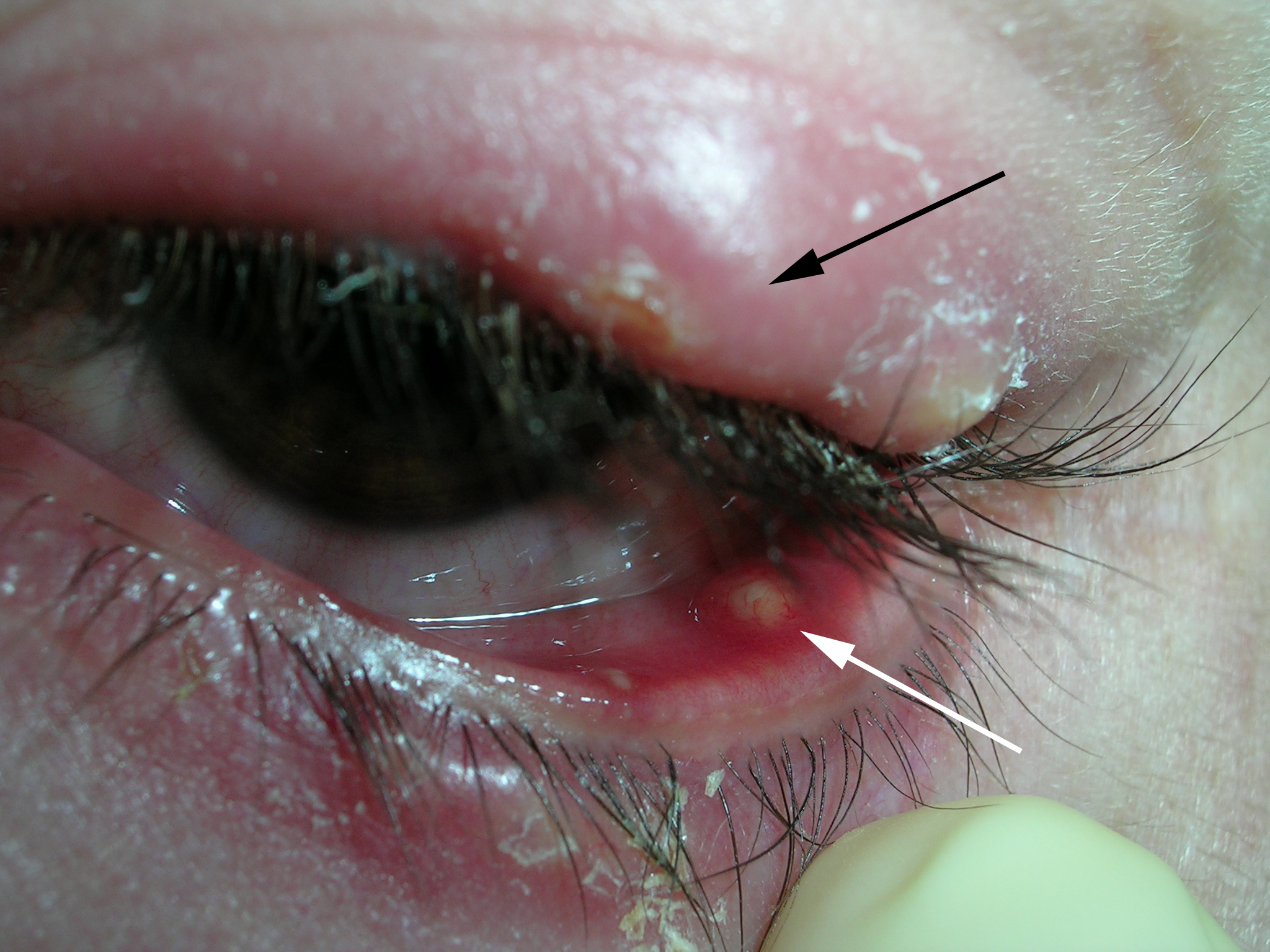 lower eyelid edema