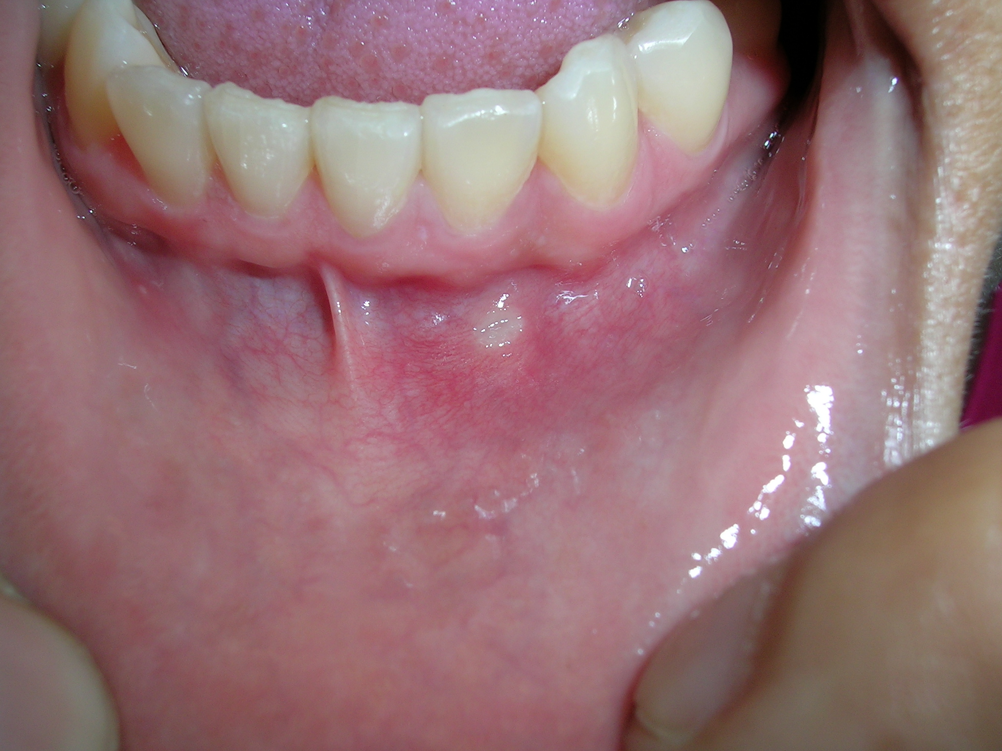 Swollen Mouth With Ulcers Infoupdate