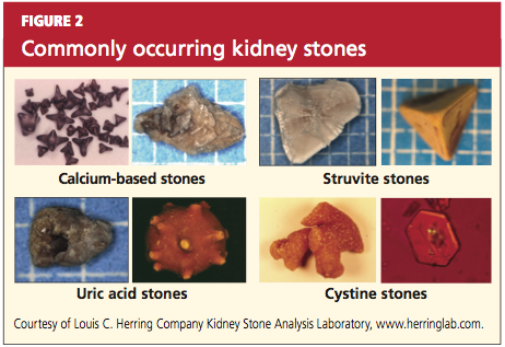 typical presentation of kidney stones